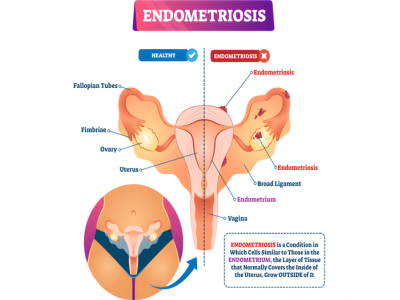 Endometriosis - kulkarnisclinic.com