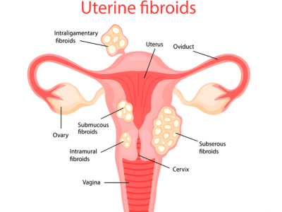 Fibroids and Cysts - kulkarnisclinic.com