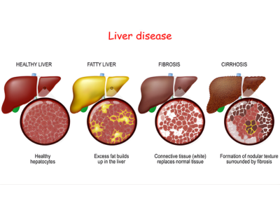 Liver Diseases (1) - kulkarnisclinic.com
