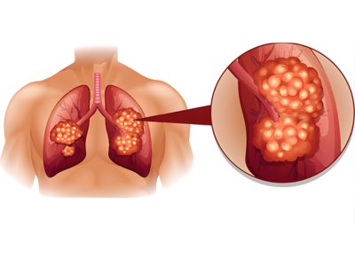 Oncological Conditions - kulkarnisclinic.com