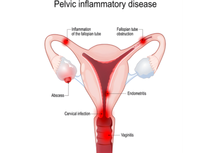 Pelvic Inflammatory Disease (PID) - kulkarnisclinic.com