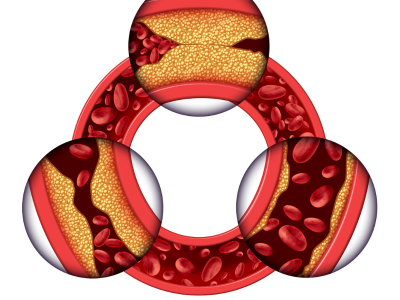 Peripheral Vascular Disease - kulkarnisclinic.com