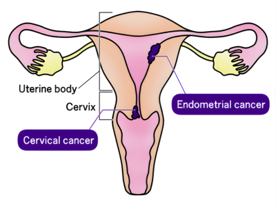 Uterine Cancer - kulkarnisclinic.com