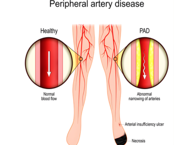 Vascular Conditions - kulkarnisclinic.com