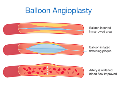 Balloon Dilatation - kulkarnisclinic.com