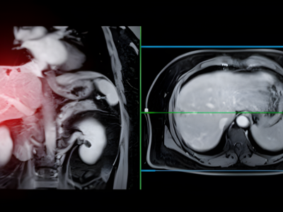 MRI with Liver-Specific Contrast - kulkarnisclinic.com