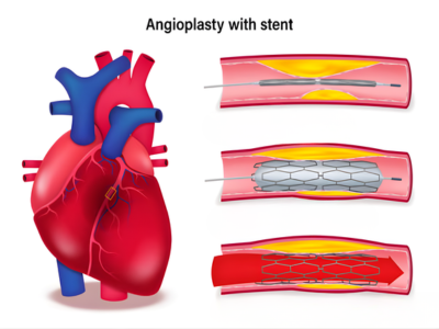 Stent Placement If Required - kulkarnisclinic.com