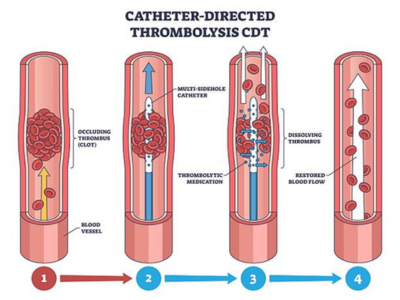 Thrombolysis - kulkarnisclinic.com