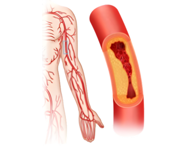Arterial Blockages in Upper Limbs - kulkarnisclinic.com