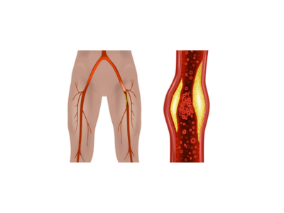Blood Clots in Peripheral Arteries - kulkarnisclinic.com