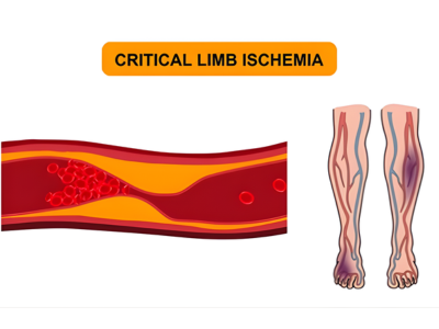 Critical Limb Ischemia - kulkarnisclinic.com