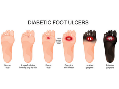 Non-Healing Ulcers and Diabetic Foot - kulkarnisclinic.com