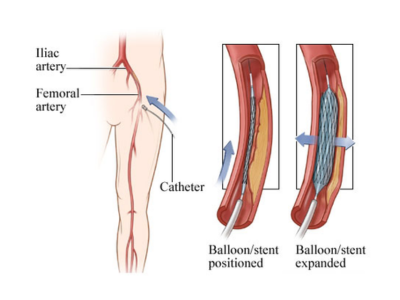 Peripheral Angiography Treatment in Navi Mumbai