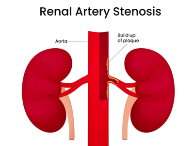 Renal Artery Stenosis - kulkarnisclinic.com
