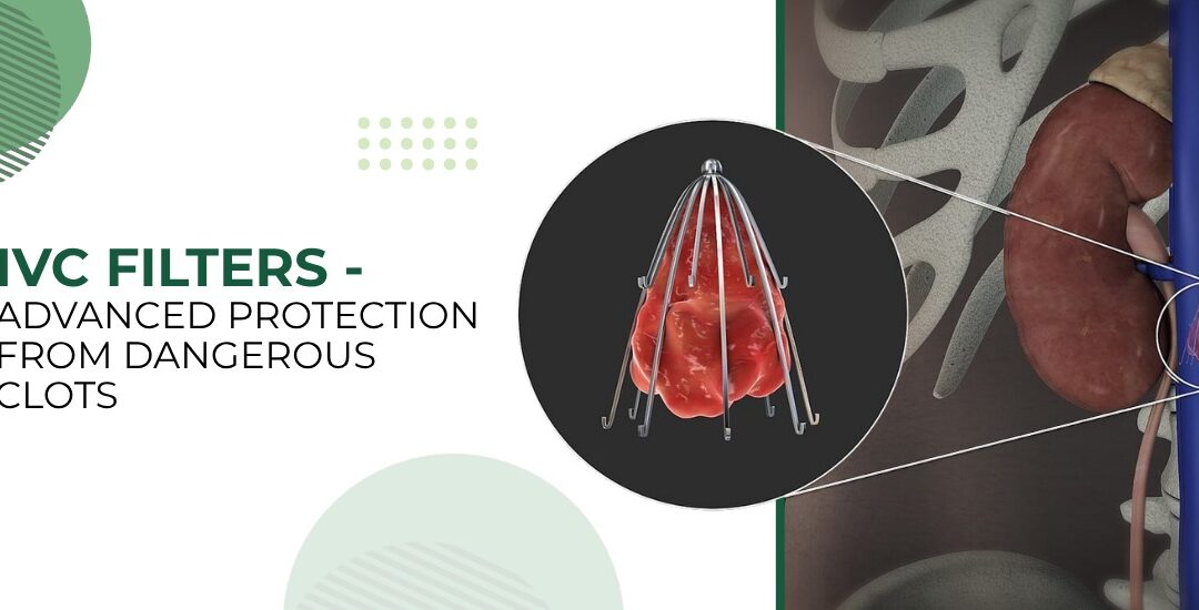 Understanding IVC Filters: A Crucial Tool in Blood Clot Prevention