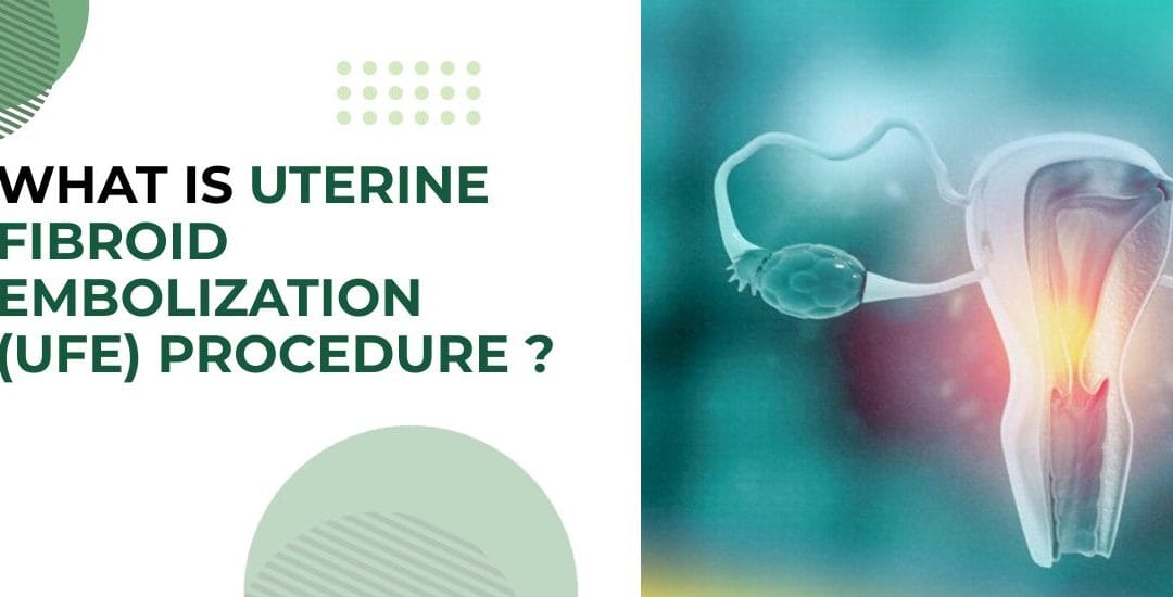 What Is Uterine Fibroid Embolization (UFE) Procedure?