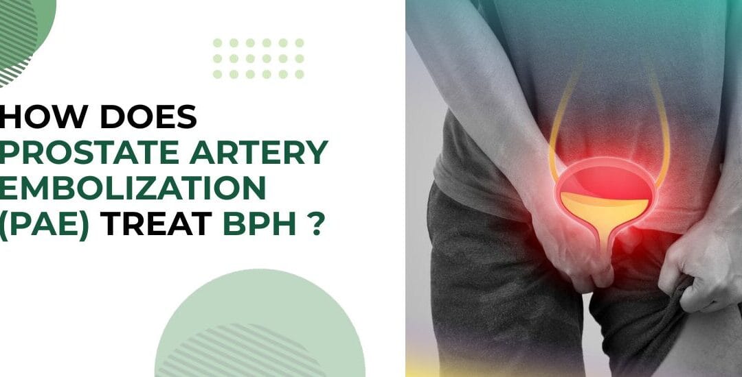 How Does Prostate Artery Embolization (PAE) Treat BPH?