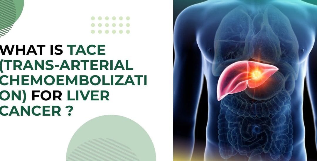 What Is TACE (Trans-Arterial Chemoembolization) for Liver Cancer?