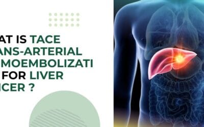 What Is TACE (Trans-Arterial Chemoembolization) for Liver Cancer?