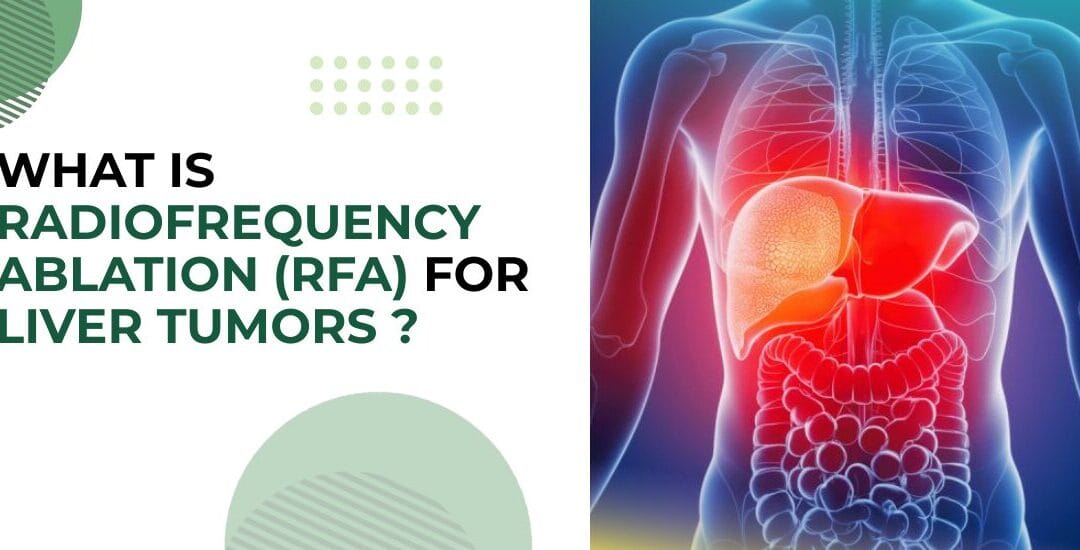 What Is Radiofrequency Ablation (RFA) for Liver Tumors?