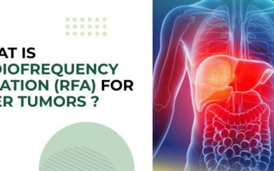 What Is Radiofrequency Ablation (RFA) for Liver Tumors?