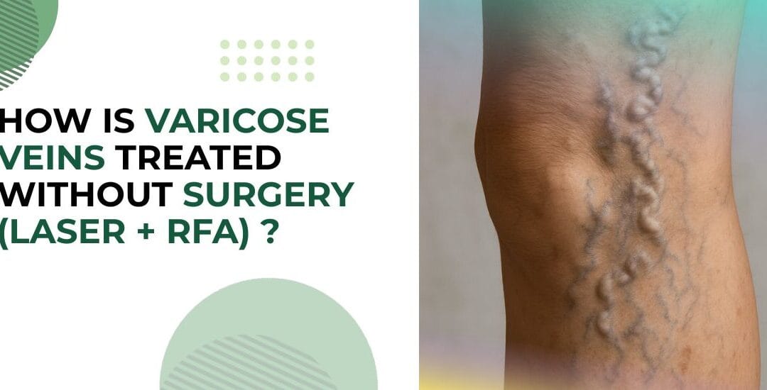 How Is Varicose Veins Treated Without Surgery (Laser + RFA)?