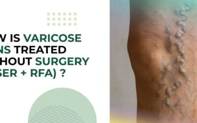 How Is Varicose Veins Treated Without Surgery (Laser + RFA)?